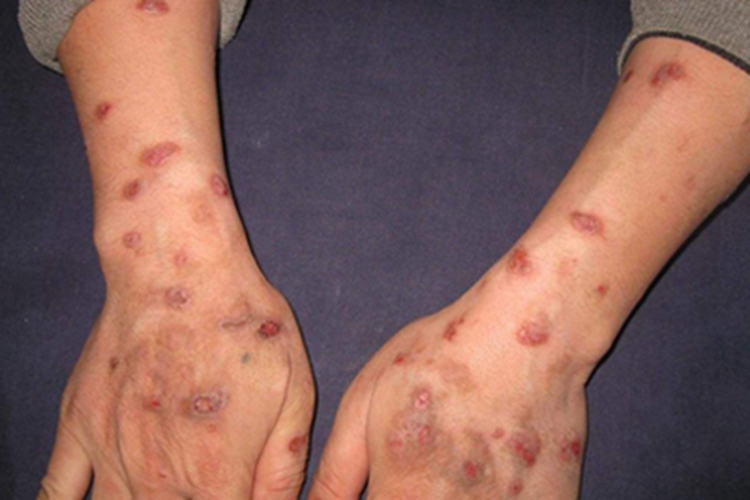 痒疹手背疙瘩图