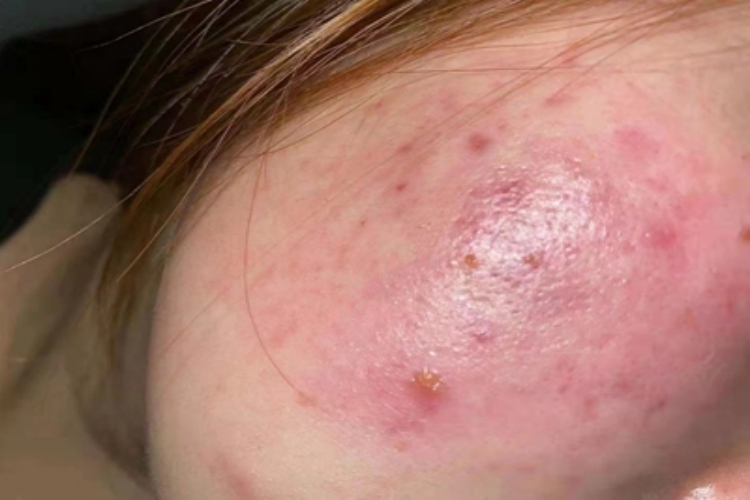 面部皮炎脸颊有红斑图 面部皮炎脸颊有红斑图