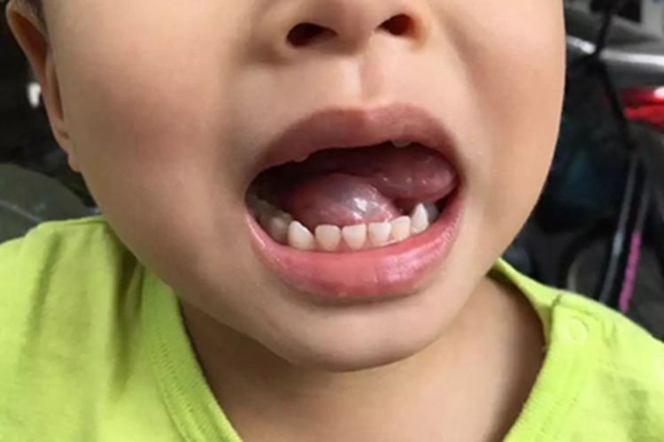 舌下腺囊肿舌头囊肿 舌下腺囊肿舌头囊肿