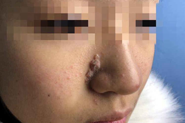 皮脂腺痣鼻部小疙瘩图