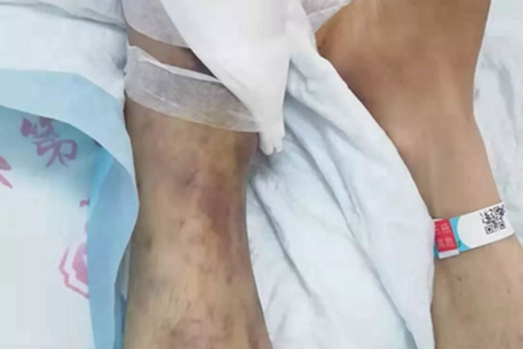 老年性紫癜脚背紫斑图