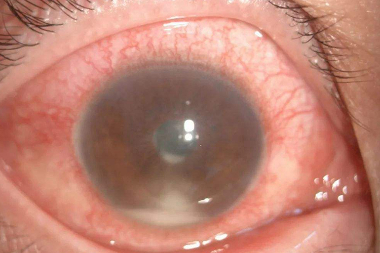 后葡萄膜炎初期图