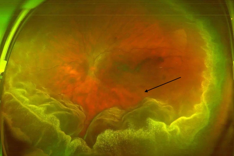 渗出性视网膜脱离图