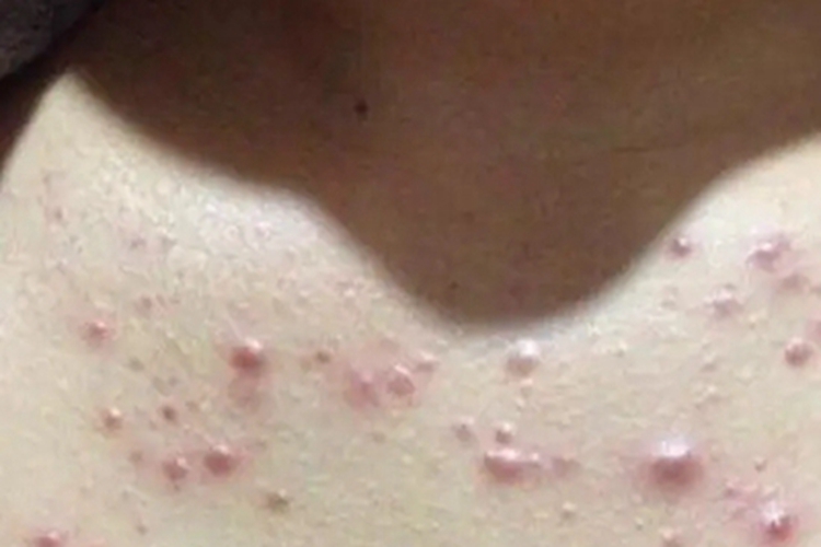 色素性痒疹胸部症状图 色素性痒疹胸部症状图