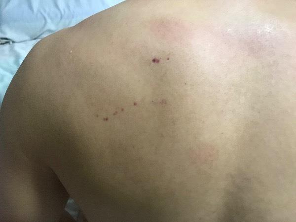 外伤后背紫色斑点图