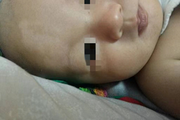 无色素痣额头有块斑图