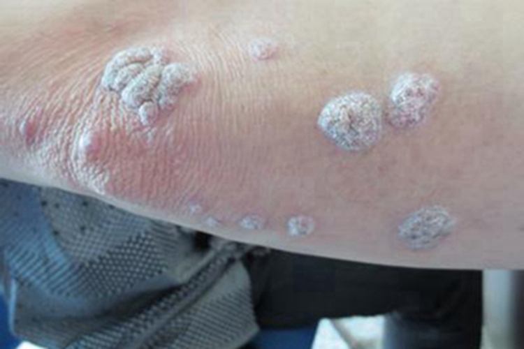 职业性疣赘胳膊疙瘩图