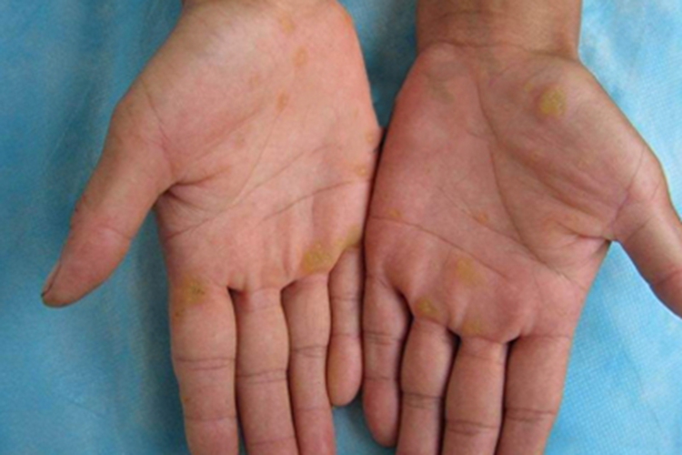 获得性掌跖角化病手掌皮肤发黄图 获得性掌跖角化病手掌皮肤发黄图