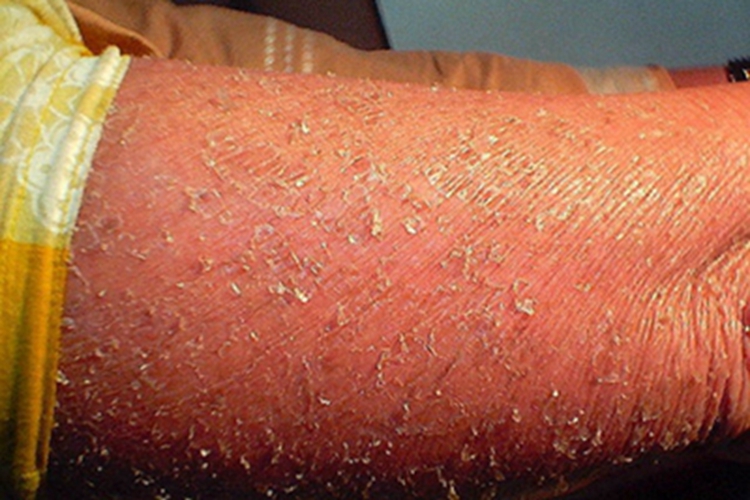 板层状鱼鳞病脱屑图