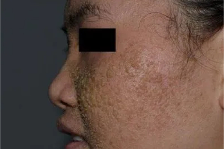 皮肤垢着病面部结痂图