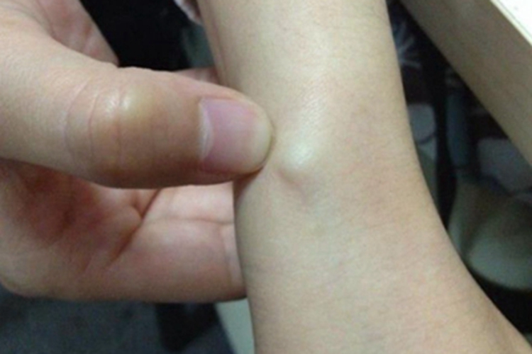 手腕腱鞘囊肿手腕有小肿块图