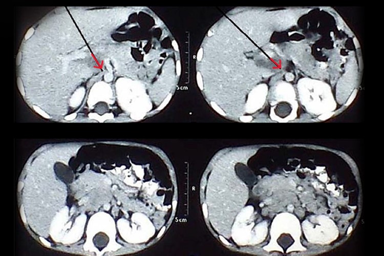 霍奇金淋巴瘤影像图