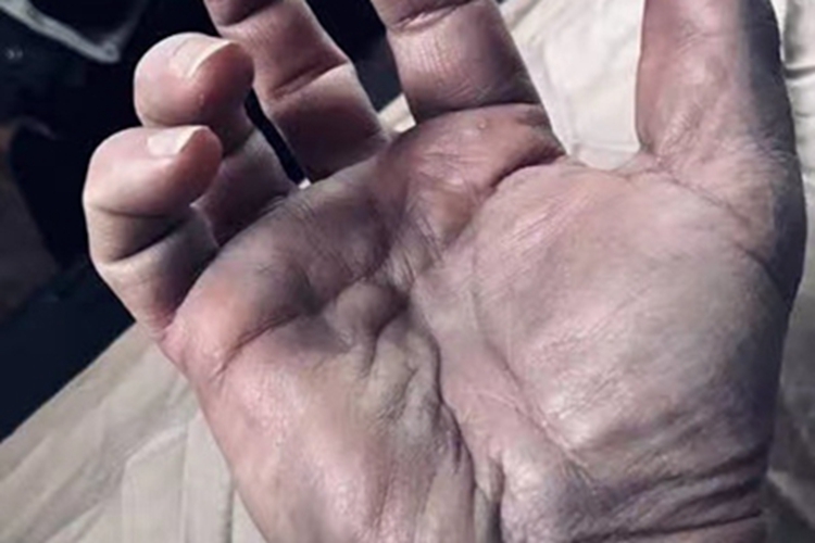 肩手综合征手部畸形图