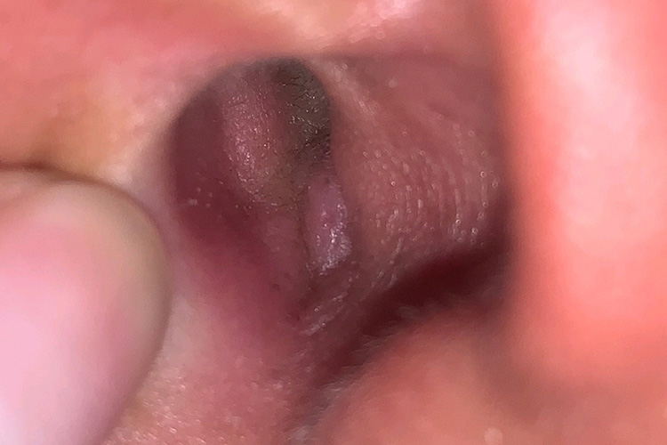 外耳道疖肿图 外耳道疖肿图