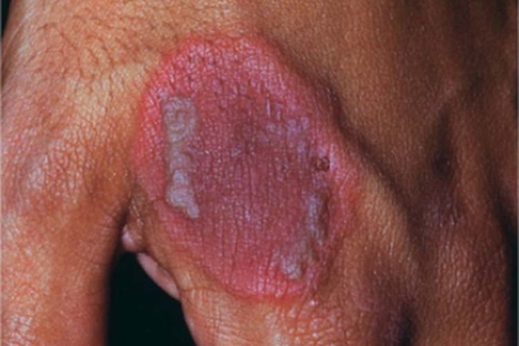 中毒性表皮坏死松解症手背溃疡图