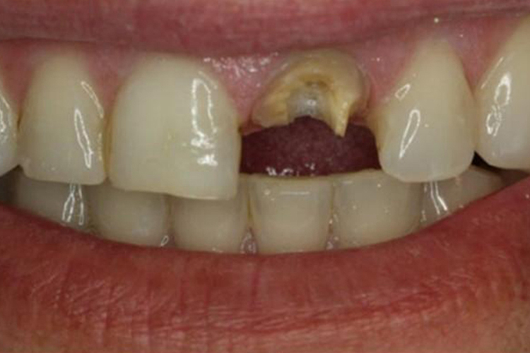 暴露牙髓的断牙图 暴露牙髓的断牙图