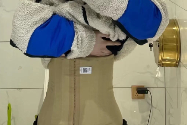 腰腹部脂肪抽吸术第10天效果图