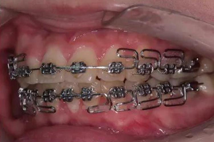 方丝弓矫治器图 方丝弓矫治器图