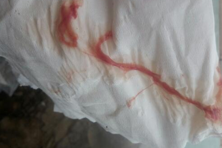 血性白带图 血性白带图