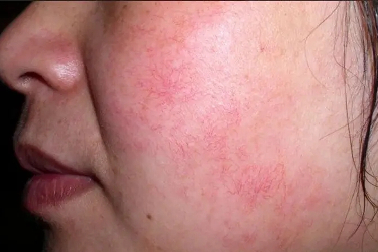 红血丝皮肤图 红血丝皮肤图