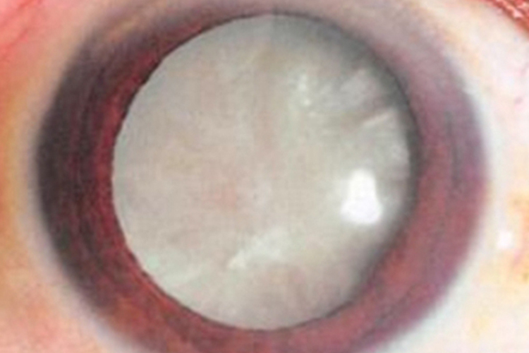 皮质性白内障眼球混浊图