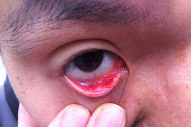 内睑腺炎图 内睑腺炎图