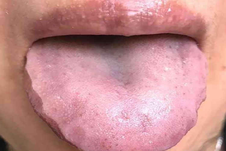 脾虚湿盛齿痕舌图