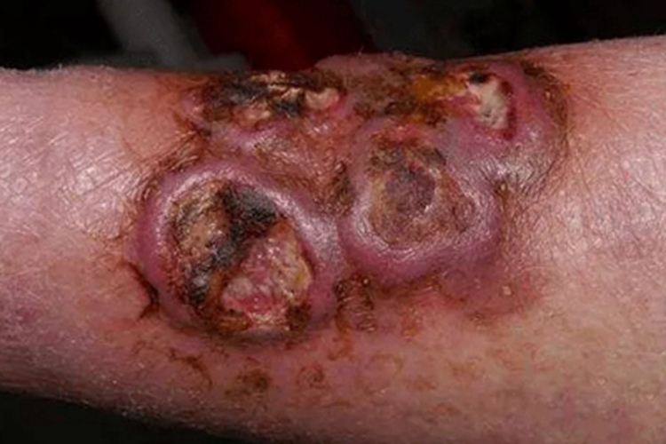 结节性脂膜炎小腿溃疡图 结节性脂膜炎小腿溃疡图