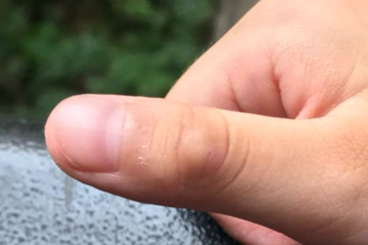 孩子手指上皮肤脂肪瘤图