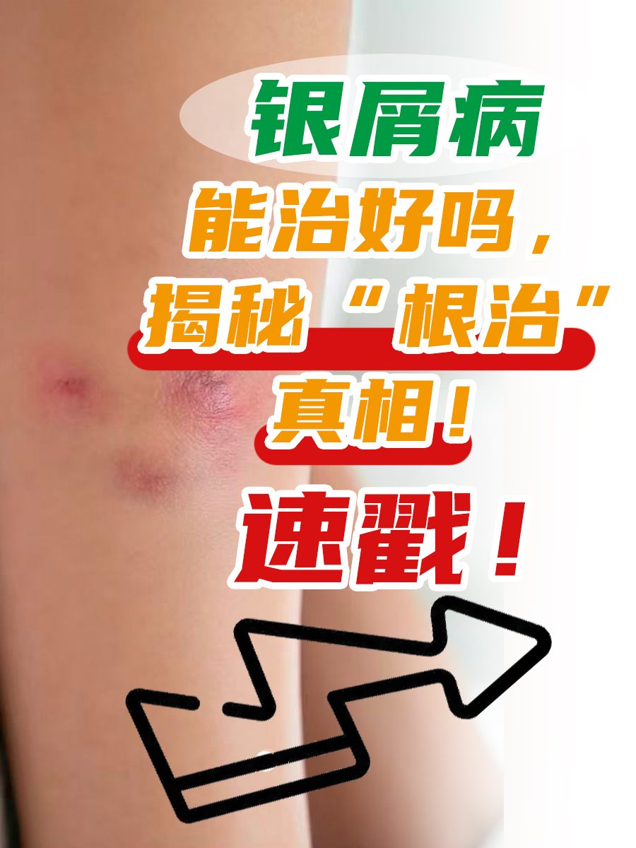 银屑病能治好吗,揭秘“根治”真相!速戳!