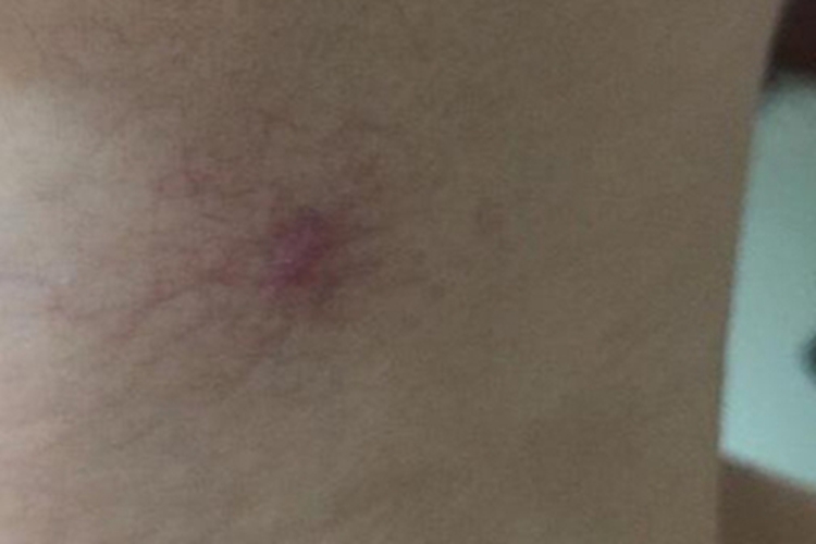 蜘蛛痣颈部症状图 蜘蛛痣颈部症状图