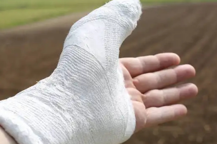 指骨骨折手打石膏图