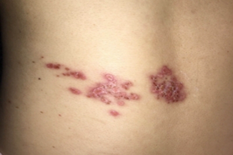 柯萨奇湿疹背部结痂图