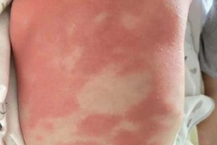 海鲜过敏后背大片红斑图