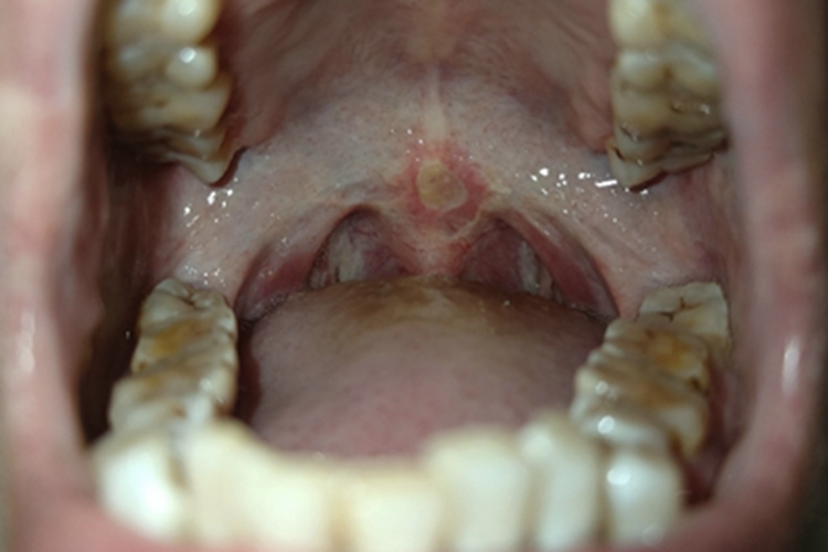 口腔溃疡软腭发生溃疡图