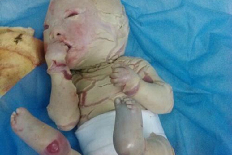 火棉胶婴儿全身皲裂脱皮图 火棉胶婴儿全身皲裂脱皮图