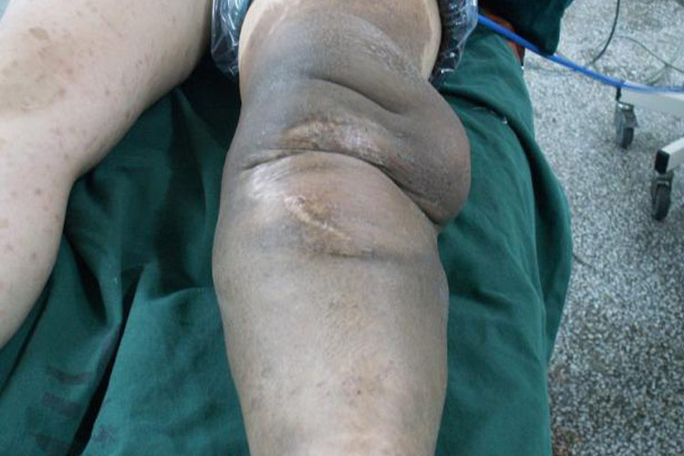 神经纤维瘤性象皮病图