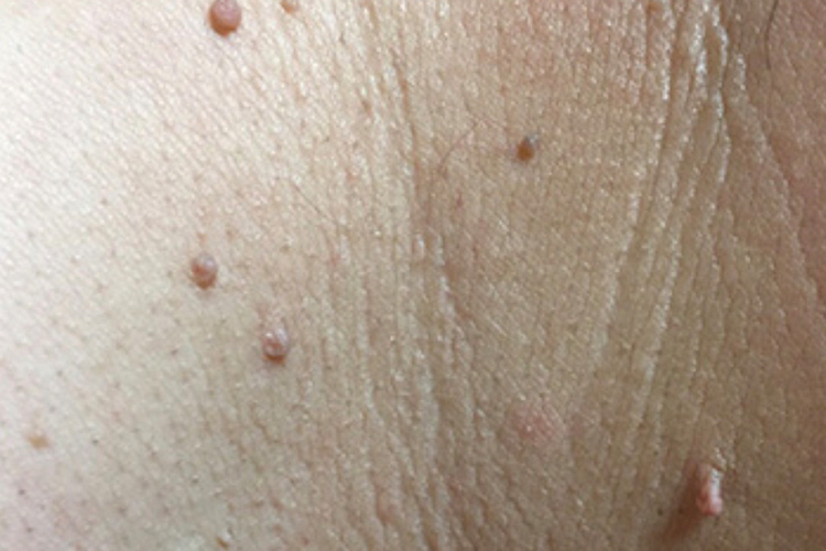 腋下扁平疣图 腋下扁平疣图