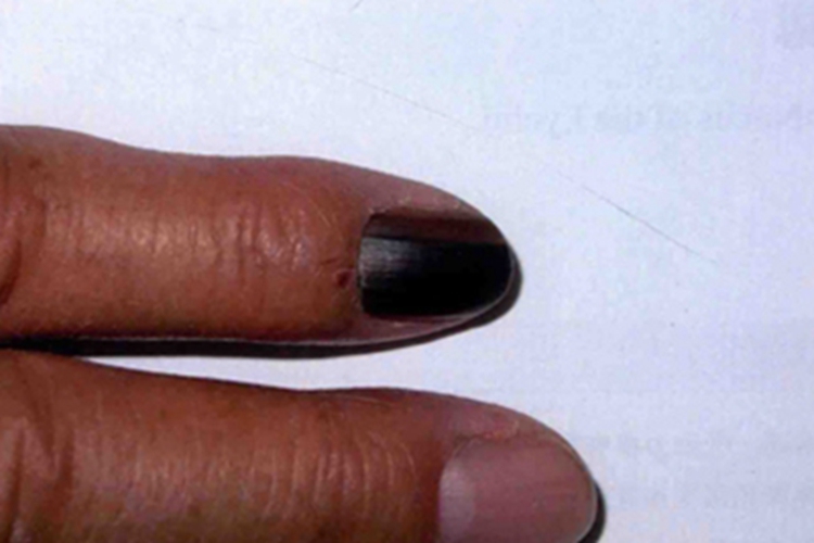 甲母痣手指甲症状图