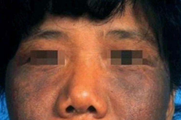 焦油性黑变病脸颊变黑图