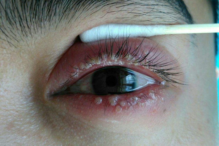 溃疡性睑缘炎眼皮肿图