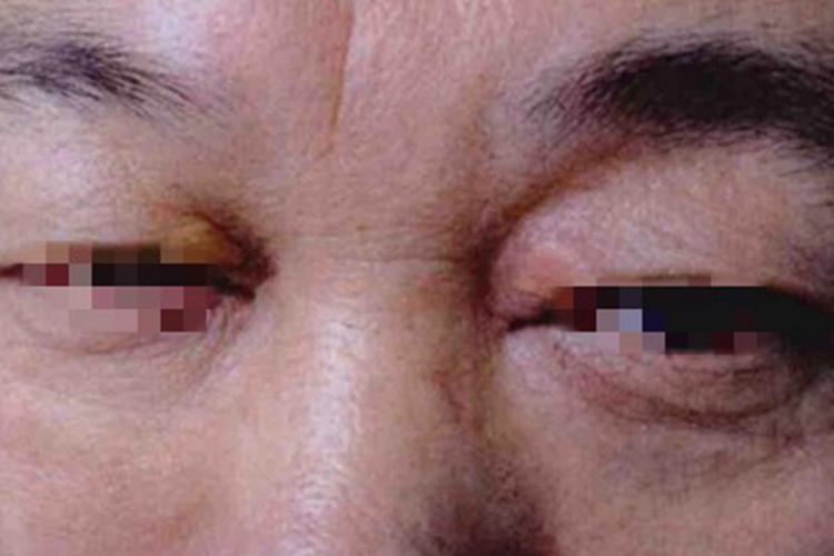 睑黄瘤眼睑小疙瘩图 睑黄瘤眼睑小疙瘩图