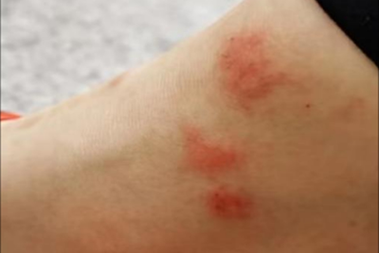 蚊虫叮咬脚踝长红疙瘩图