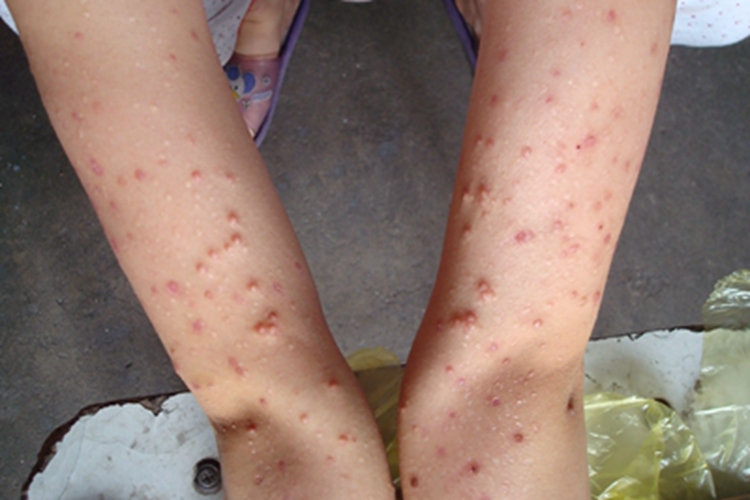 丘疹坏死性结核疹胳膊症状图