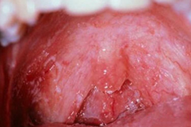 艾滋病期嘴里有白斑图 艾滋病期嘴里有白斑图