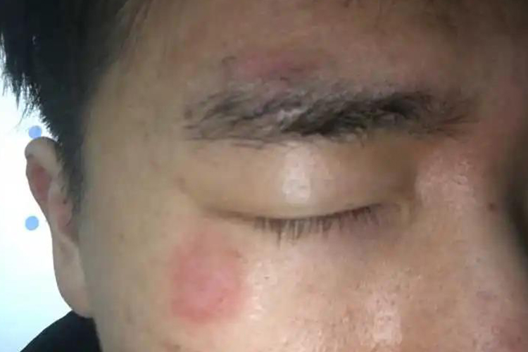 脸部擦伤掉痂后恢复图