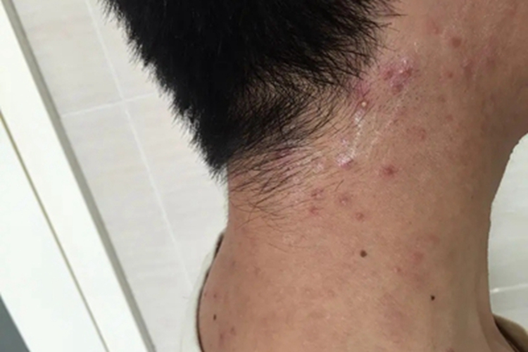 嗜酸性脓疱性毛囊炎侧颈丘疹图