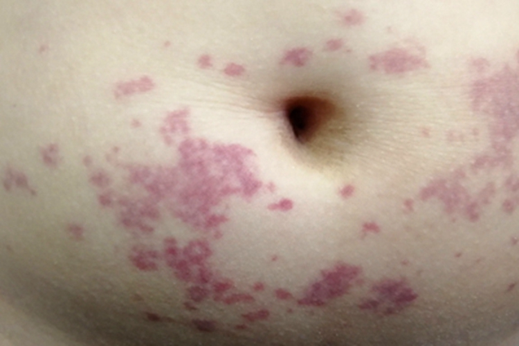 湿疹样紫癜腹部斑图