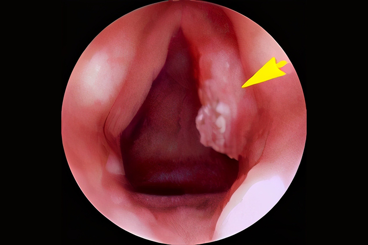喉癌内窥镜下图