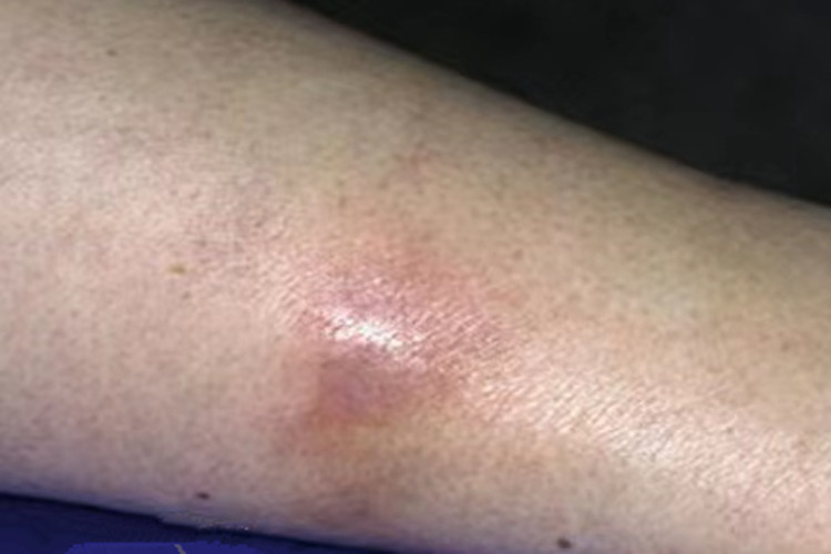 瘰疬性皮肤结核大腿症状图